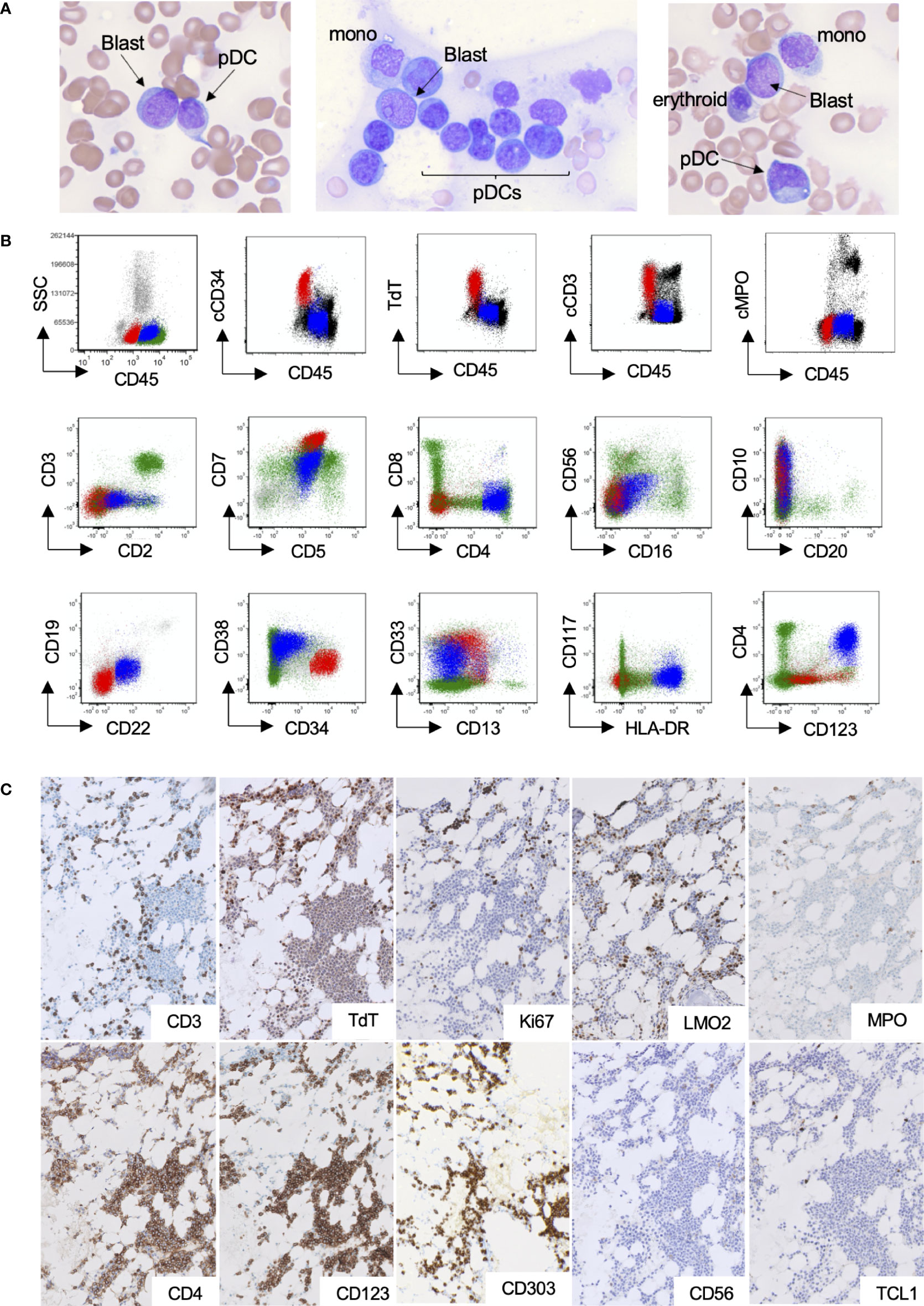 Frontiers | Case Report: Mature Plasmacytoid Dendritic Cell