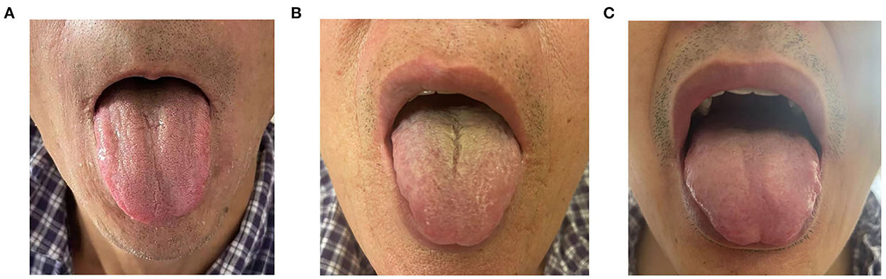 Frontiers Relationship Between Thick Or Greasy Tongue coating 