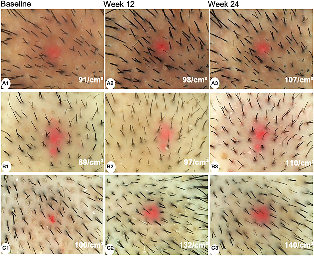Frontiers | Efficacy and Safety of 5% Minoxidil Alone, Minoxidil Plus Oral Spironolactone, and Minoxidil Plus Microneedling on Female Pattern Hair Loss: A Prospective, Single-Center, Parallel-Group, Evaluator Blinded, Randomized Trial Frontiers | Efficacy and Safety of 5% Minoxidil Alone, Minoxidil Plus Oral Spironolactone, and Minoxidil Plus Microneedling on Female Pattern Hair Loss: A Prospective, Single-Center, Parallel-Group, Evaluator Blinded, Randomized Trial