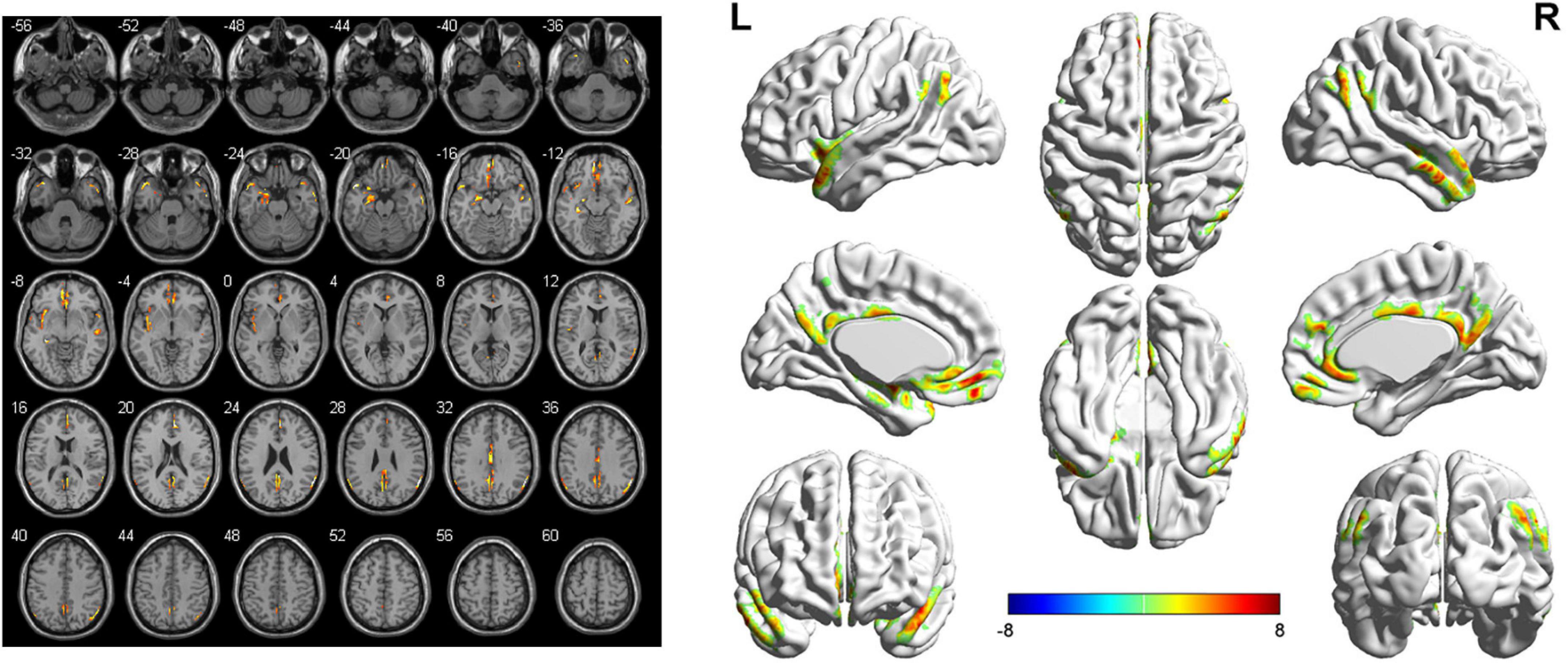 How aware are you? - Brain Aneurysm Awareness Quiz - Brain Aneurysm  Foundation