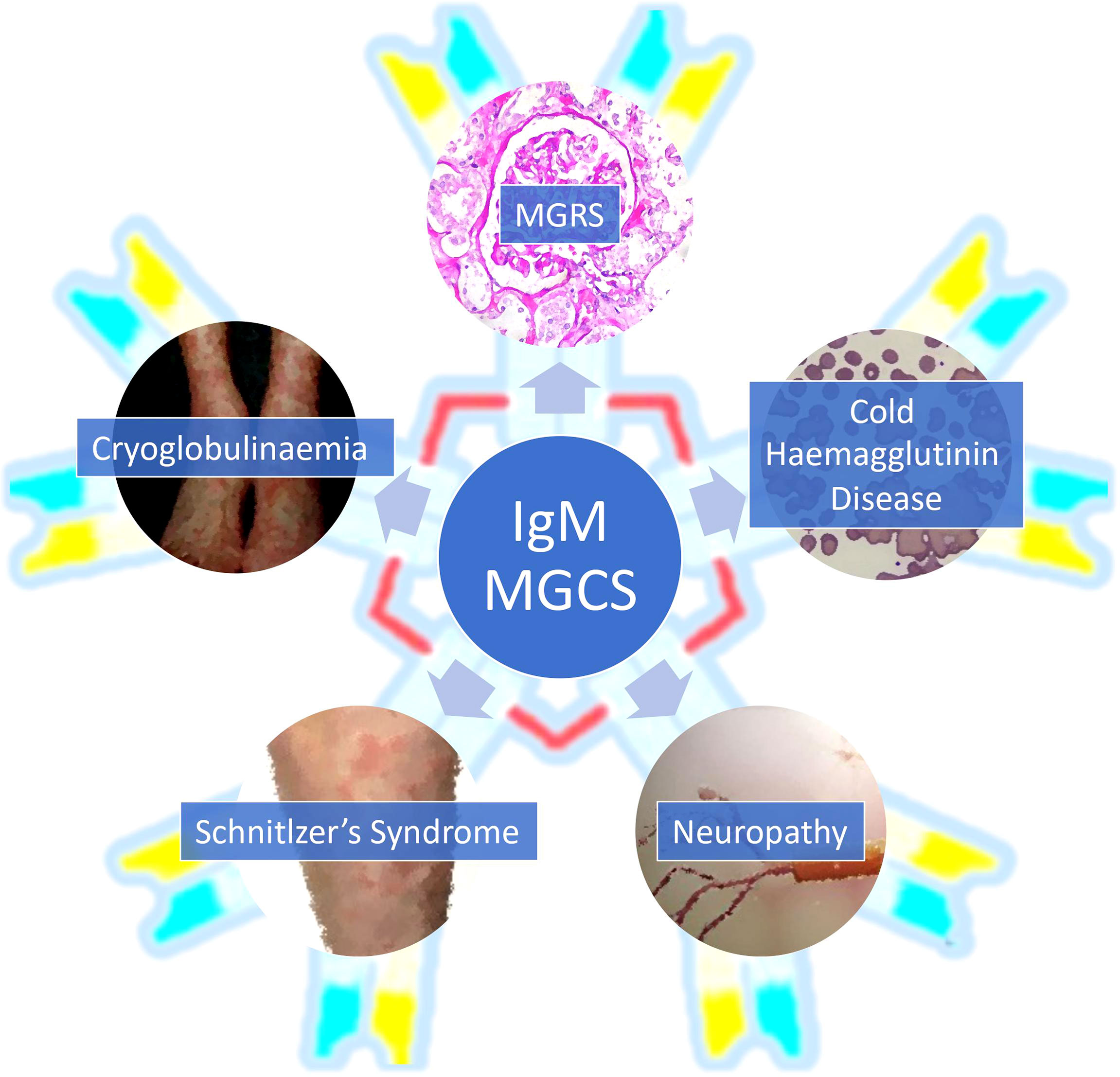 Wereldvenster Thriller Industrialiseren Frontiers | Immunoglobulin M Monoclonal Gammopathies of Clinical  Significance