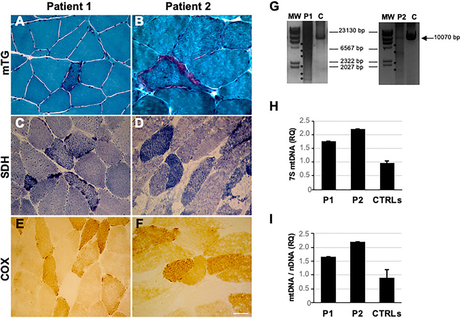 A novel C-terminal truncating NR5A1 mutation in dizygotic