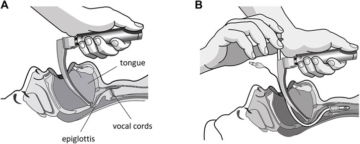 Frontiers | Design and Additive Construction of a Video-Laryngoscope ...