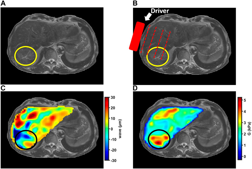 Frontiers  Multiparametric magnetic resonance imaging-derived