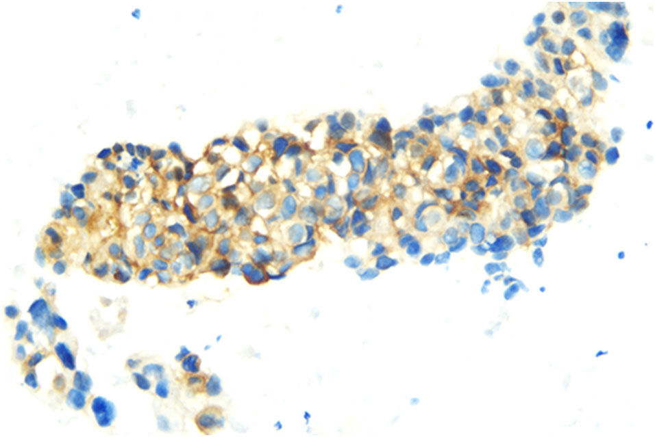 Frontiers | Case Report: Durable partial response to