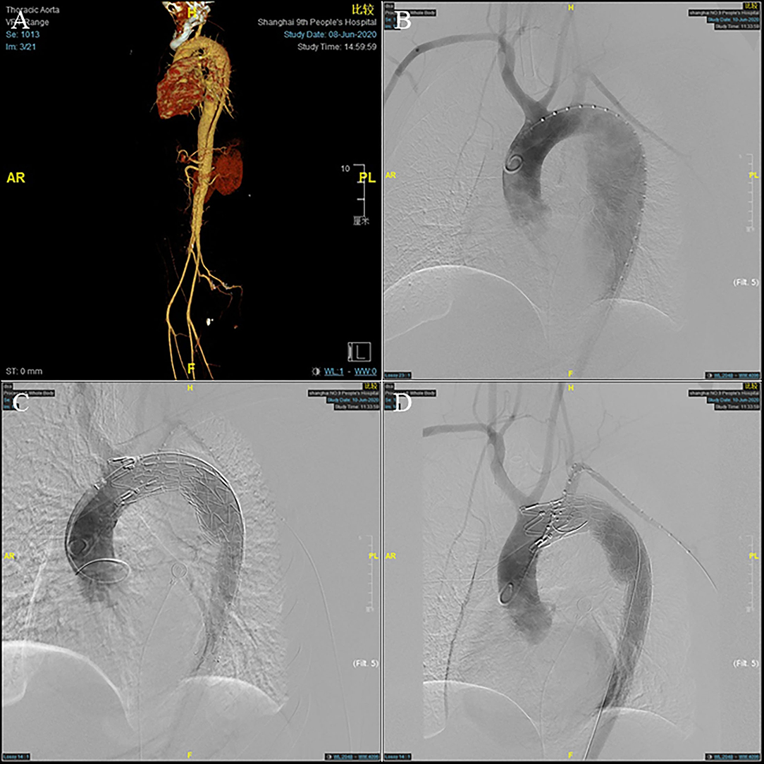 Frontiers  Clinical Validation of the Impact of Branch Stent Extension on  Hemodynamics in ISF-TEVAR Involving LSA Reconstruction