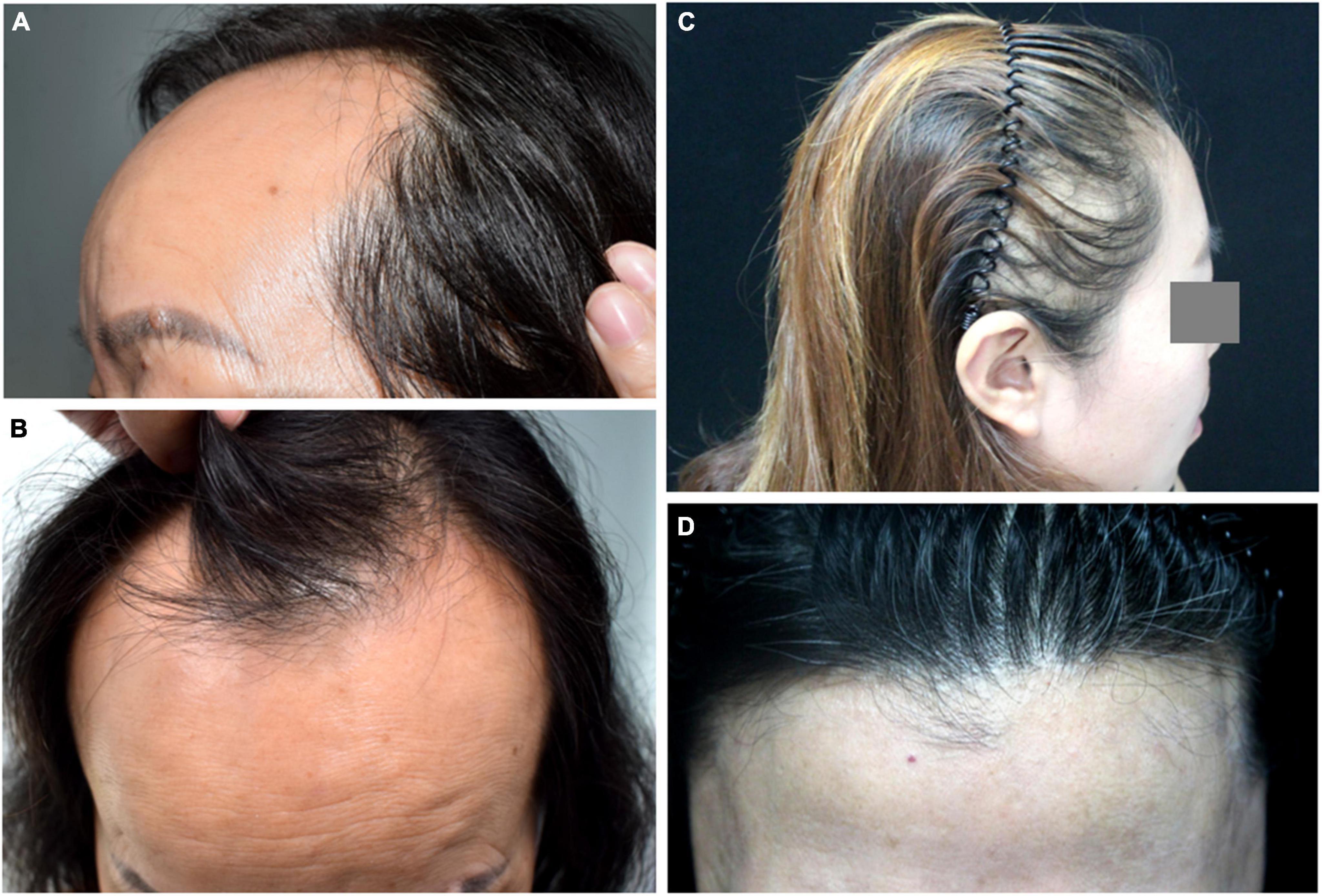 Cureus  Alopecia Areata Mimicking Frontal Fibrosing Alopecia  Article