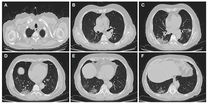 Frontiers | Association of CT Findings in Disease 2019 (COVID-19) With Patients' Age, Body Weight, Vital Signs, and Medical