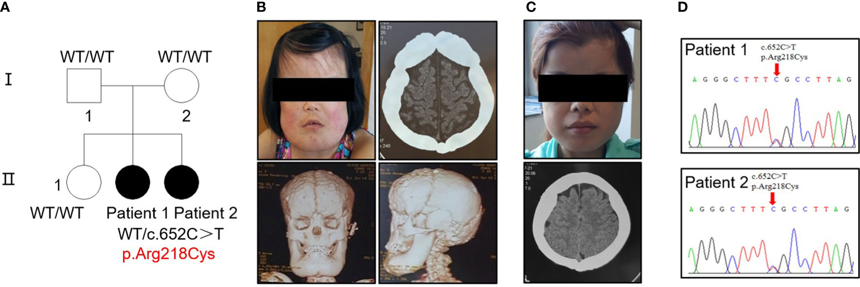 Frontiers | Aberrant activation of TGF-β1 induces high bone