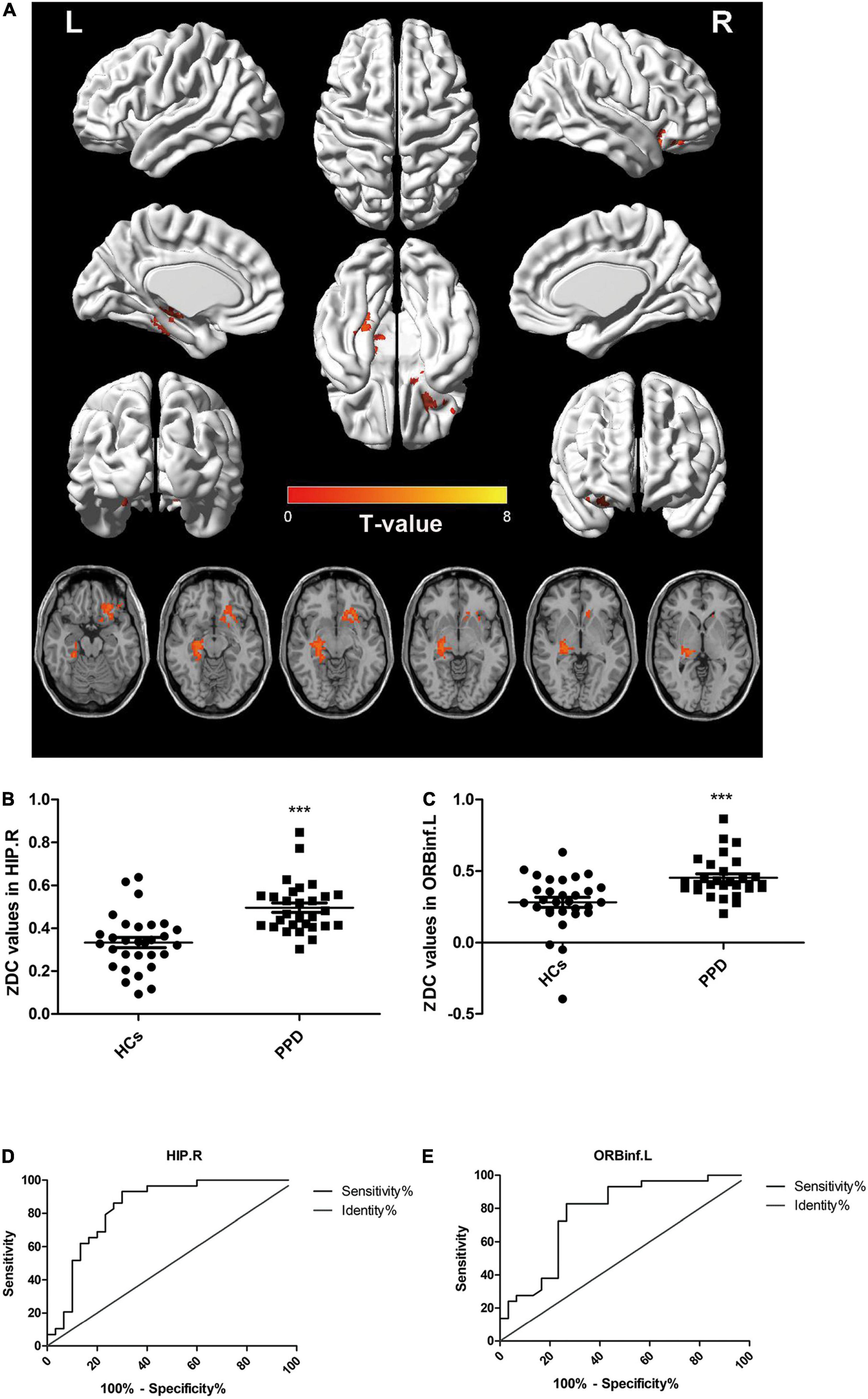 Frontiers  Neural activity in adults with major depressive disorder  differs from that in healthy individuals: A resting-state functional  magnetic resonance imaging study