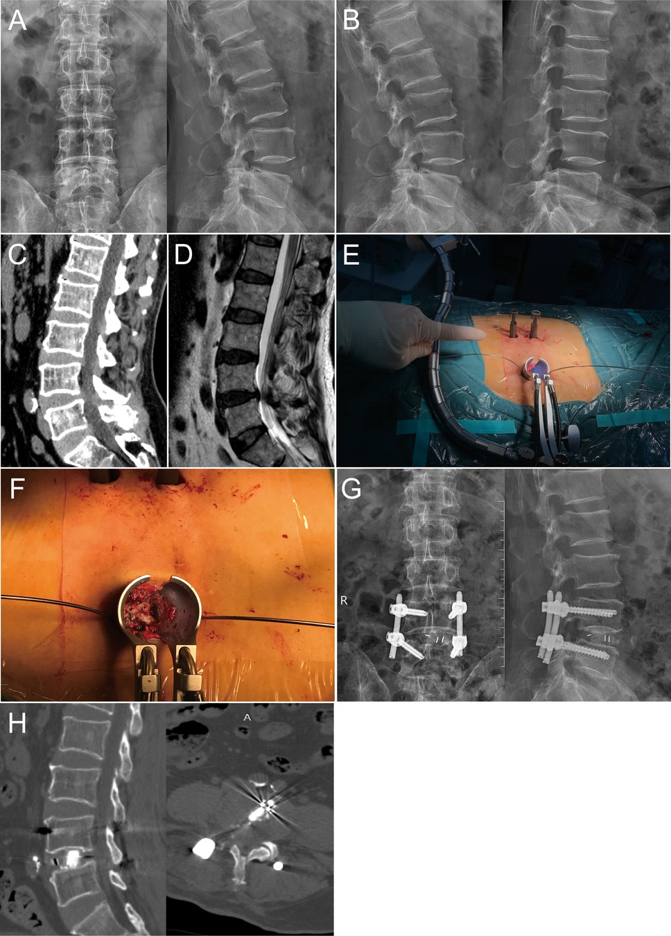 Insufflated Laparoscopic Model - PulseMDM