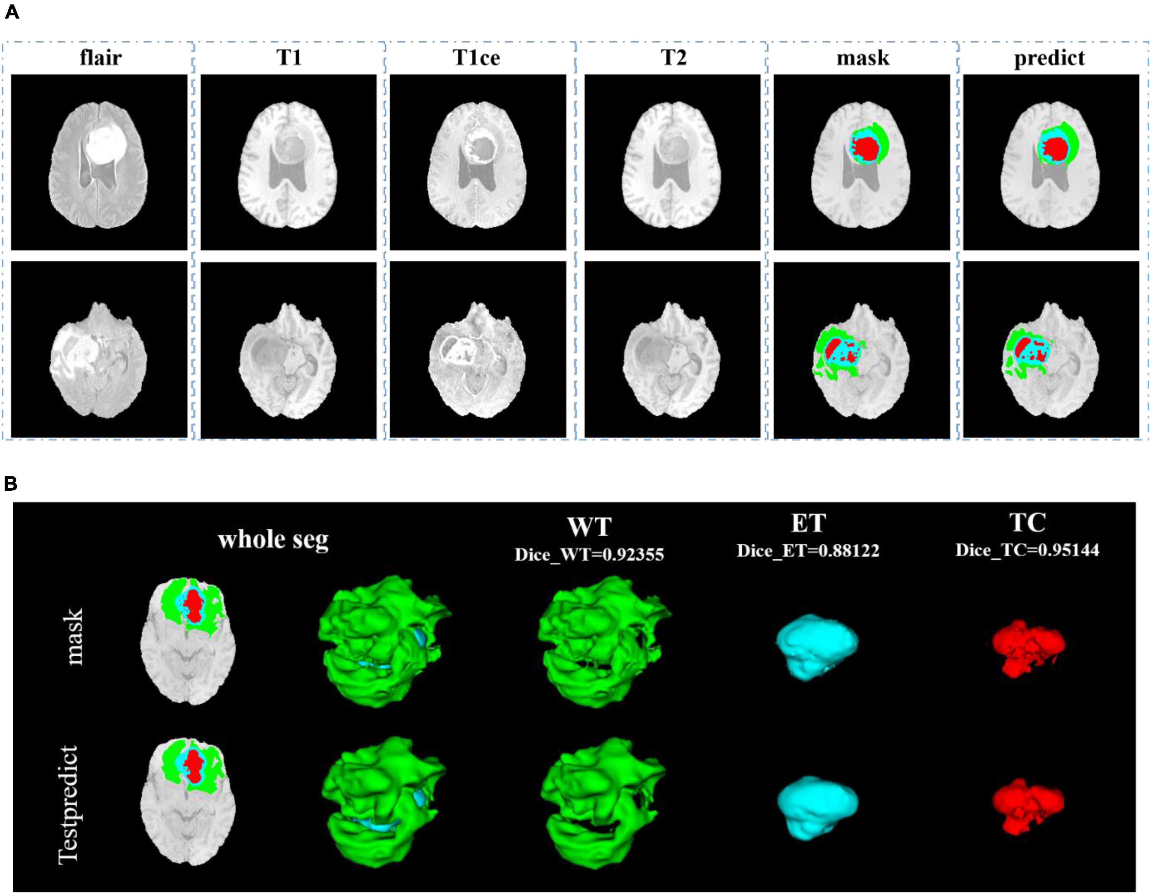 Brain tumor segmentation based on deep learning and an attention mechanism using MRI multi-modalities brain images