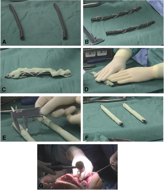 Frontiers | Treatment of Periprosthetic Joint Infection and  Fracture-Related Infection With a Temporary Arthrodesis Made by PMMA-Coated  Intramedullary Nails – Evaluation of Technique and Quality of Life in  Implant-Free Interval