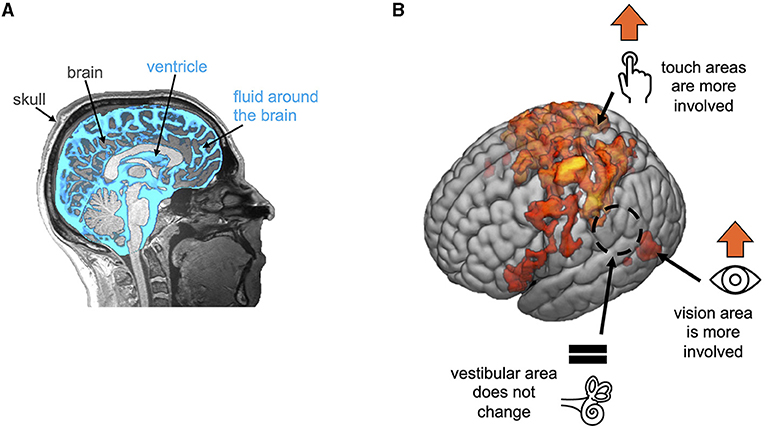 Figure 3 - (A) Example brain MRI scan.