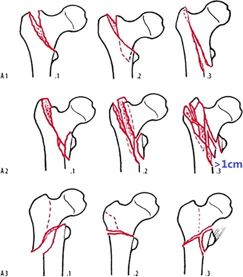 proximal femur fracture