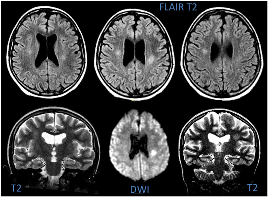 Frontiers | The Clinical Impact of Methotrexate-Induced Stroke-Like ...