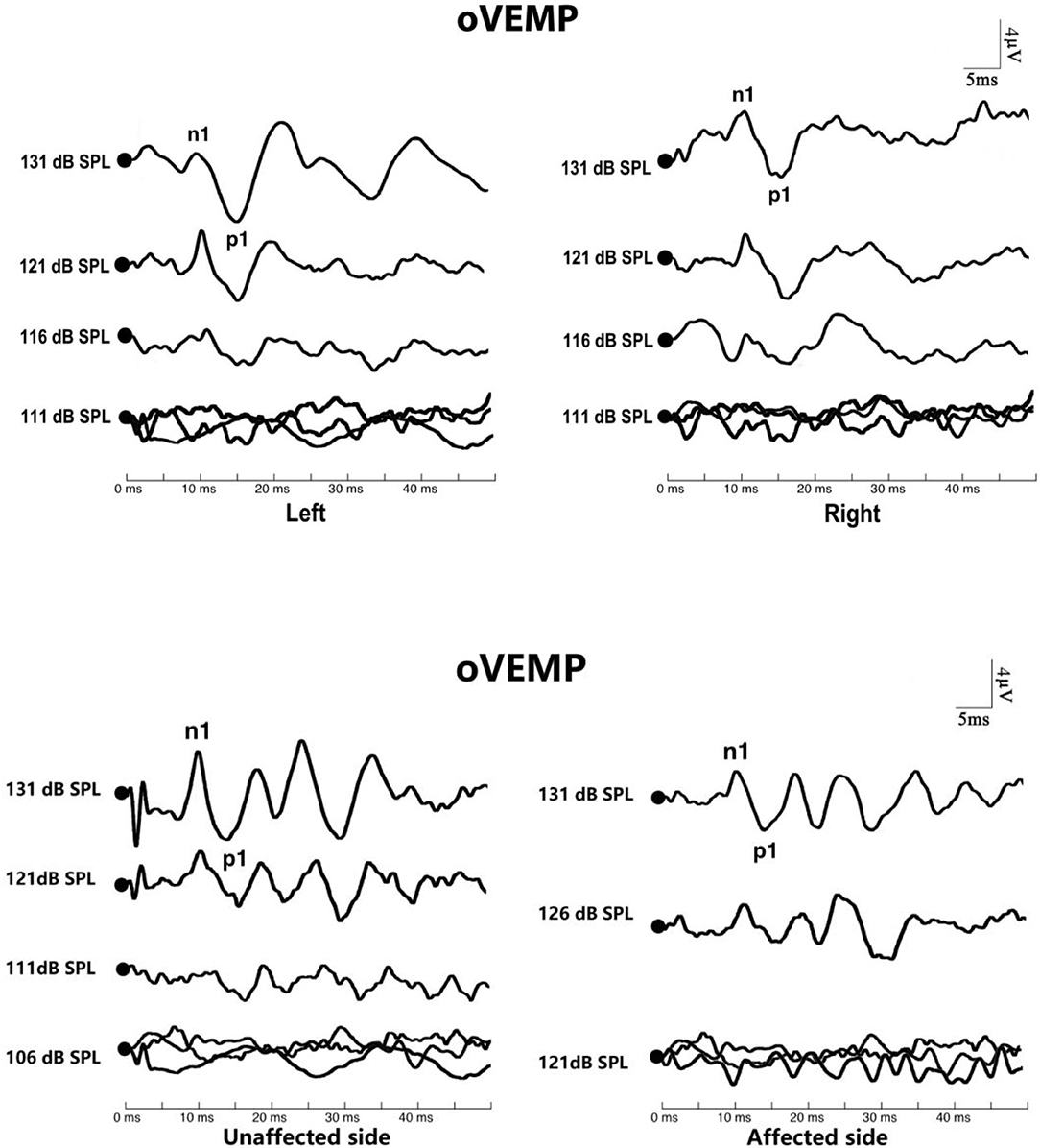 Frontiers  Correlation Between Benign Paroxysmal Positional