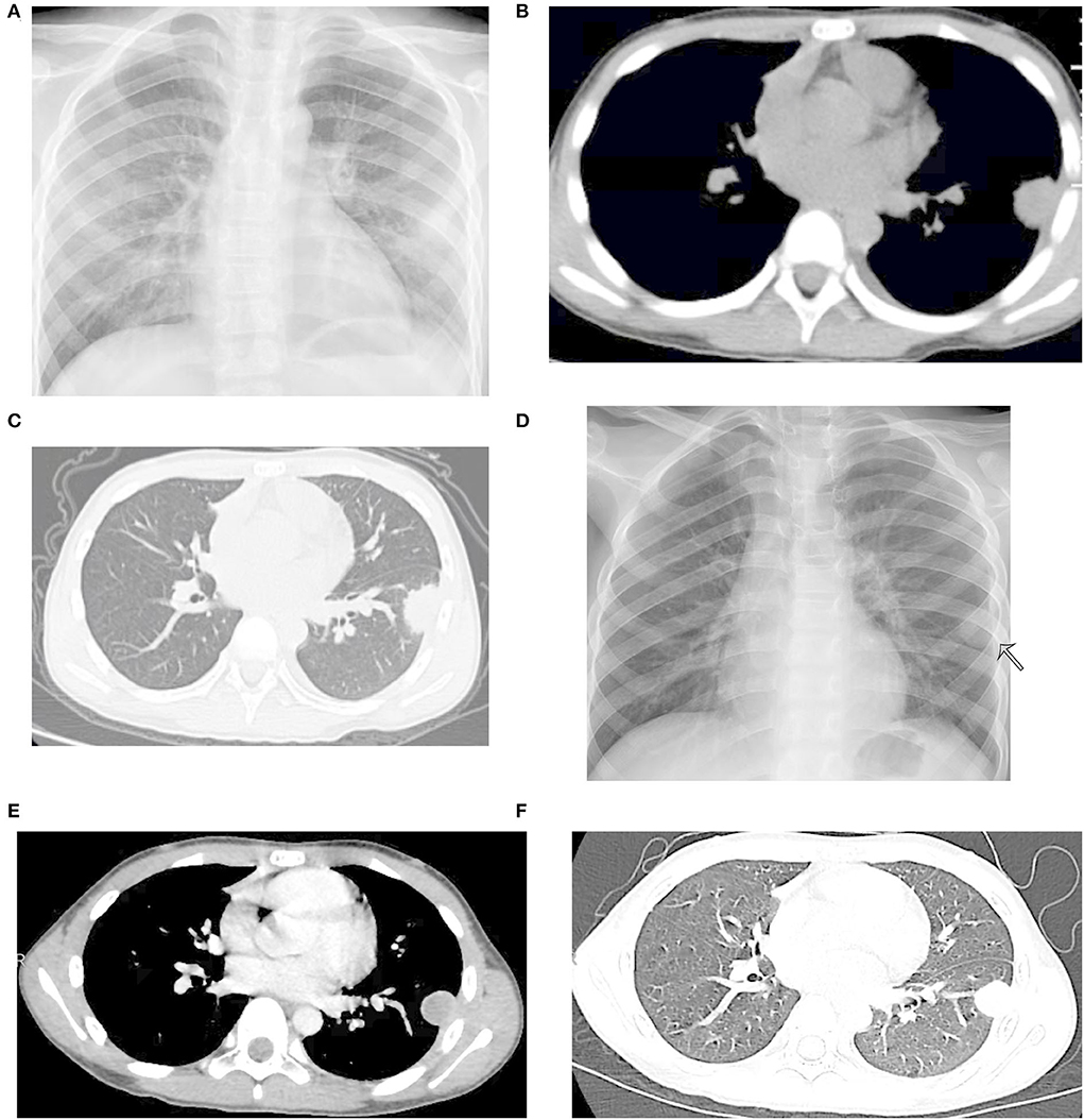 An Isolated Pulmonary Nodule Secondary To Streptococcus Intermedius an-isolated-pulmonary-nodule-secondary-to-streptococcus-intermedius