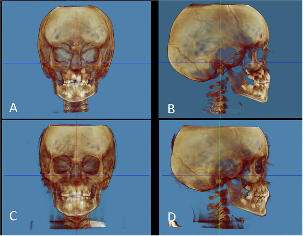 PDF] Evaluation of horizontal condylar angle in malocclusions with  mandibular lateral displacement using cone-beam computed tomography.