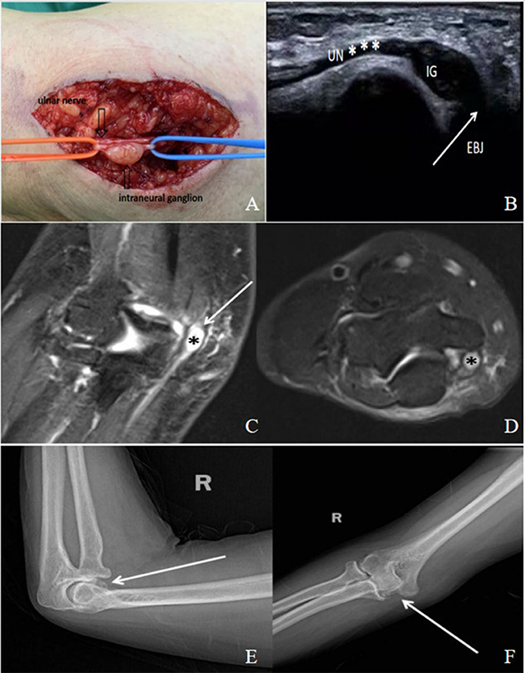 A rapidly progressive foot drop caused by the posttraumatic Intraneural  ganglion cyst of the deep peroneal nerve, BMC Musculoskeletal Disorders