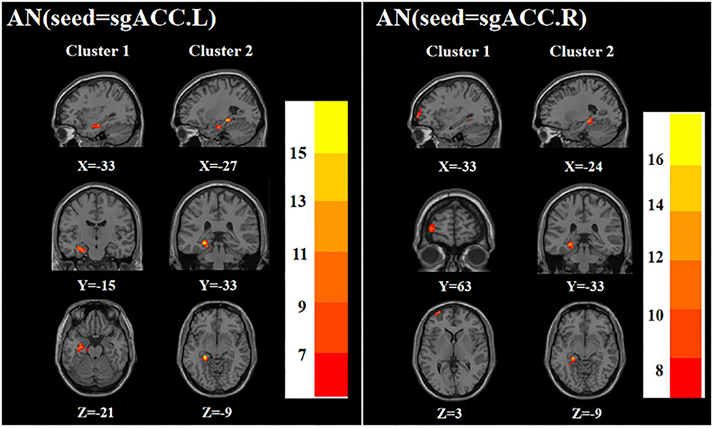 Frontiers  Neural activity in adults with major depressive disorder  differs from that in healthy individuals: A resting-state functional  magnetic resonance imaging study