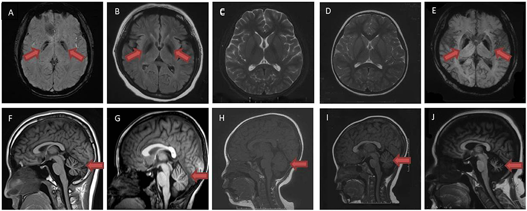 Frontiers | Novel PLA2G6 Pathogenic Variants in Chinese Patients 
