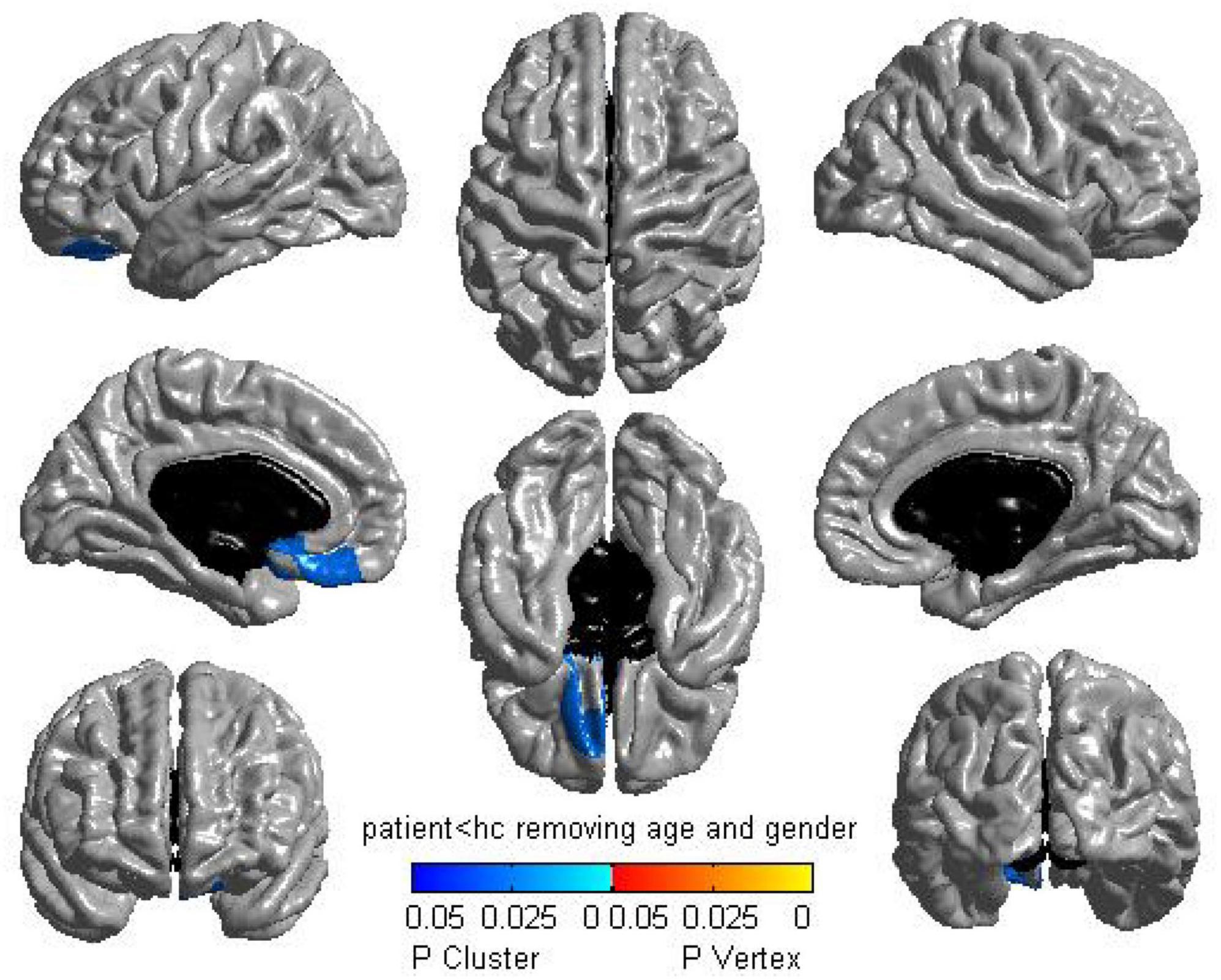 Long-term Multidomain Patterns of Change After Traumatic Brain Injury