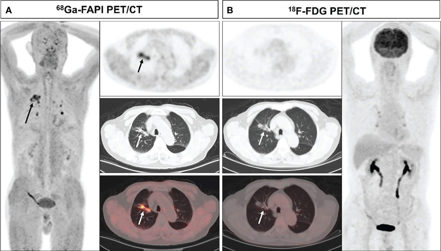 PET Imaging of Fibroblast Activation Protein in Various Types of Cancer  Using 68Ga-FAP-2286: Comparison with 18F-FDG and 68Ga-FAPI-46 in a  Single-Center, Prospective Study