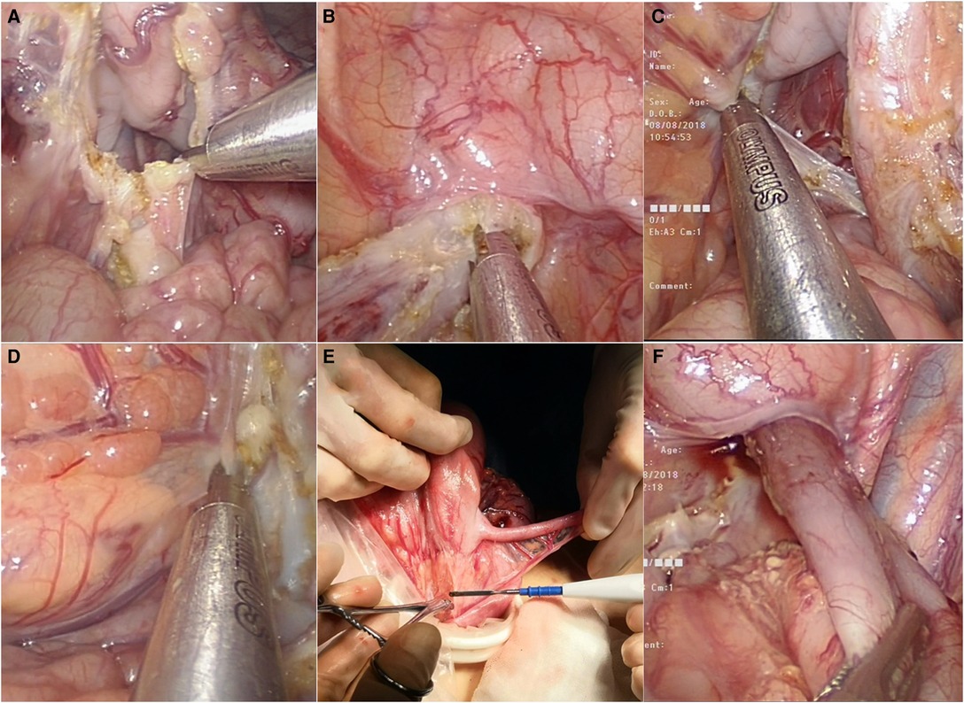 Case 52-1991 — An Eight-Year-Old Girl with Recurrent Abdominal Distention  after Surgical Correction of Hirschsprung's Disease