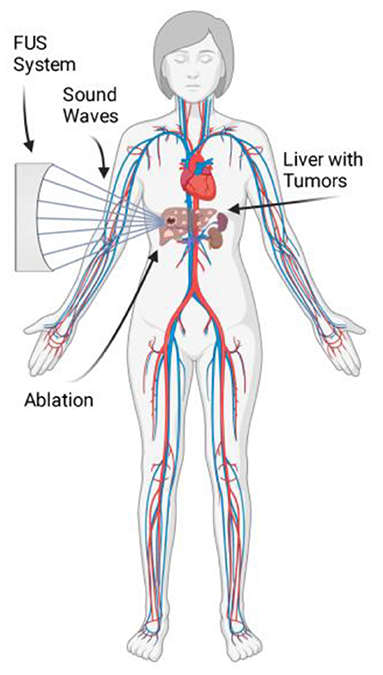 Figure 1 - A child with liver cancer could be treated with FUS.