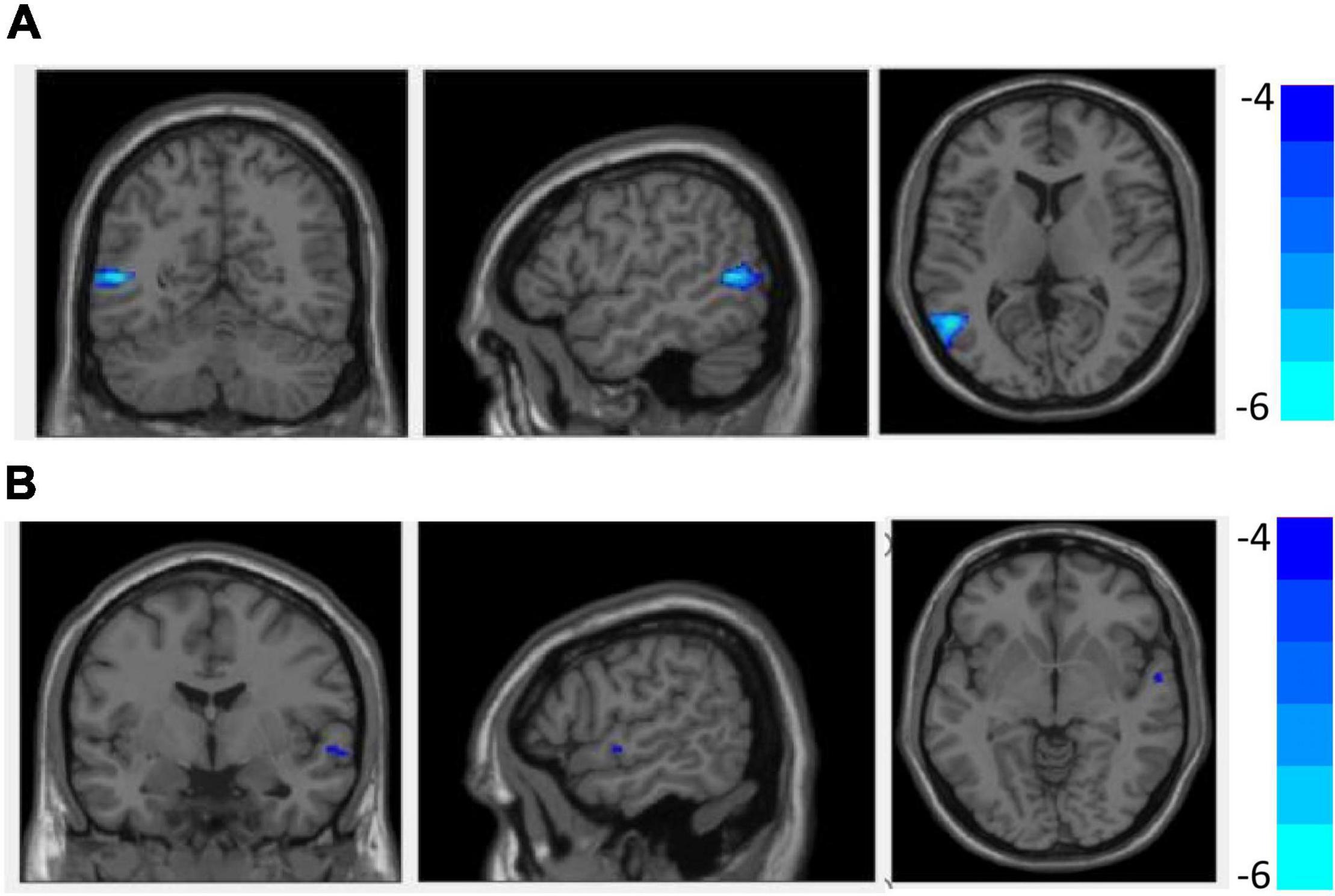 brain scan schizophrenia