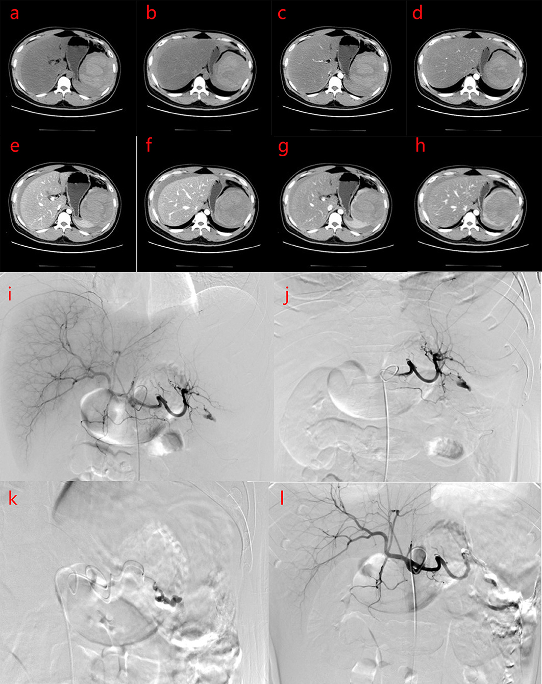 Splenic Artery Model