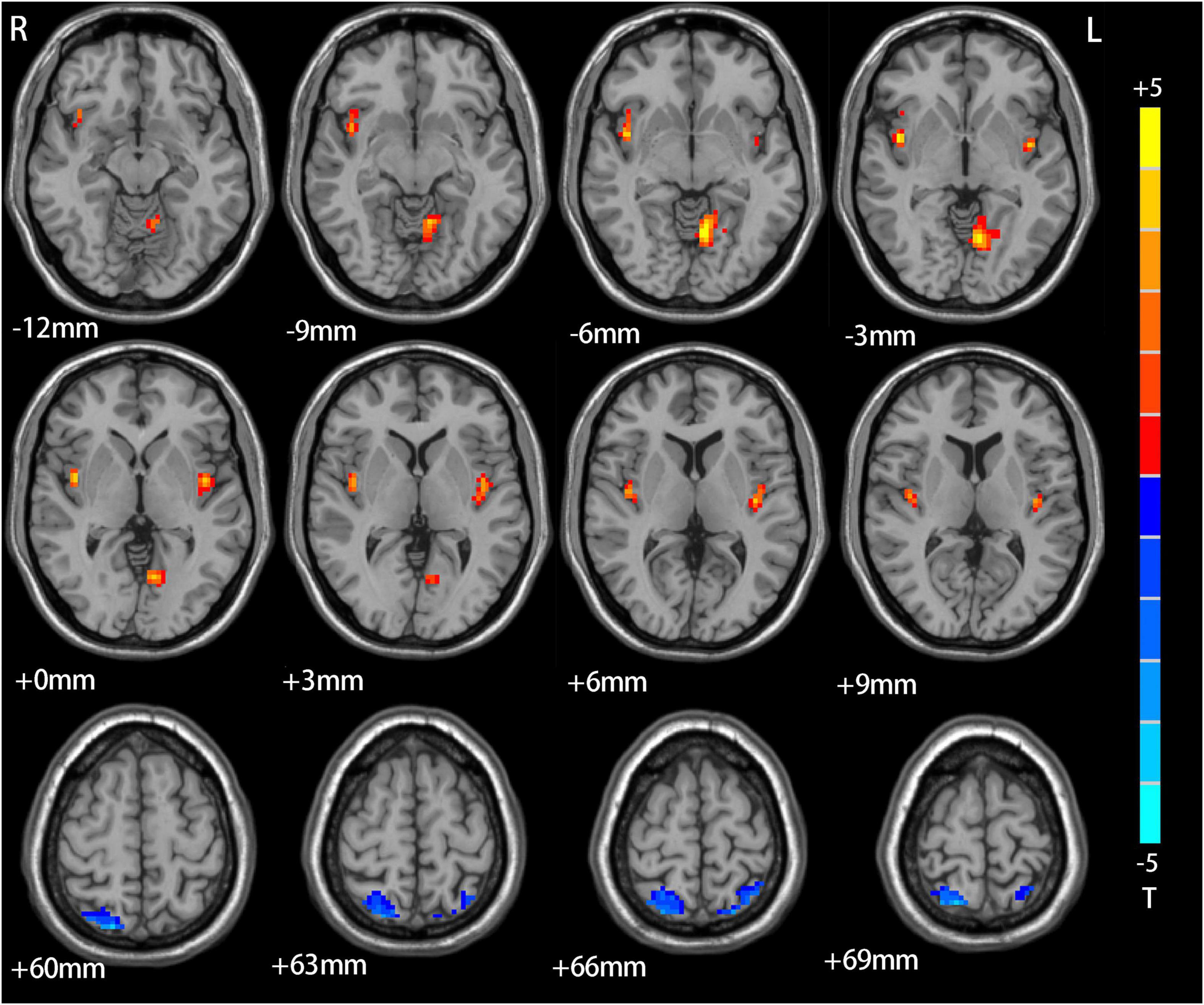 Frontiers  Neural activity in adults with major depressive disorder  differs from that in healthy individuals: A resting-state functional  magnetic resonance imaging study