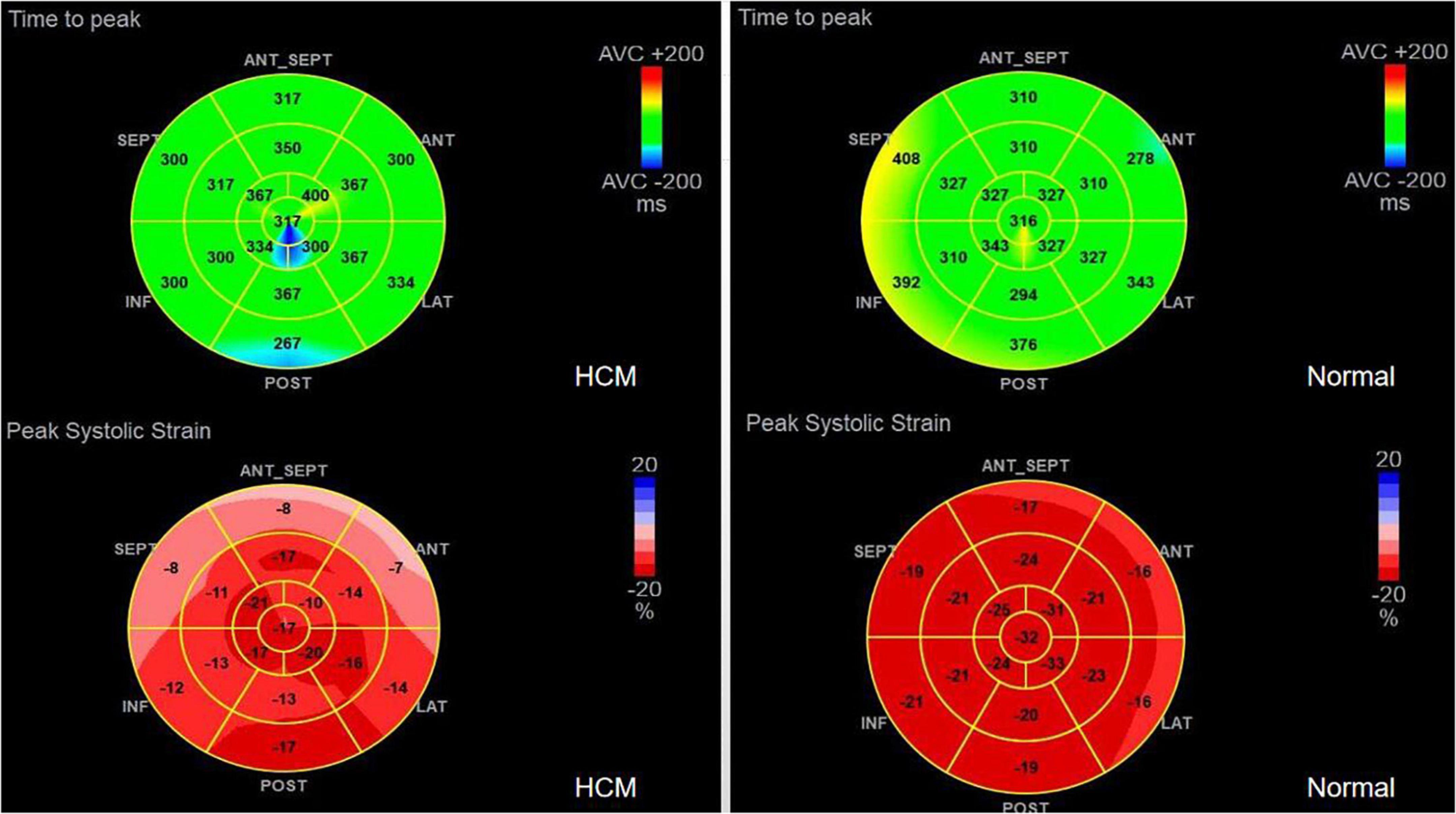 Global longitudinal strain from resting echocardiogram is