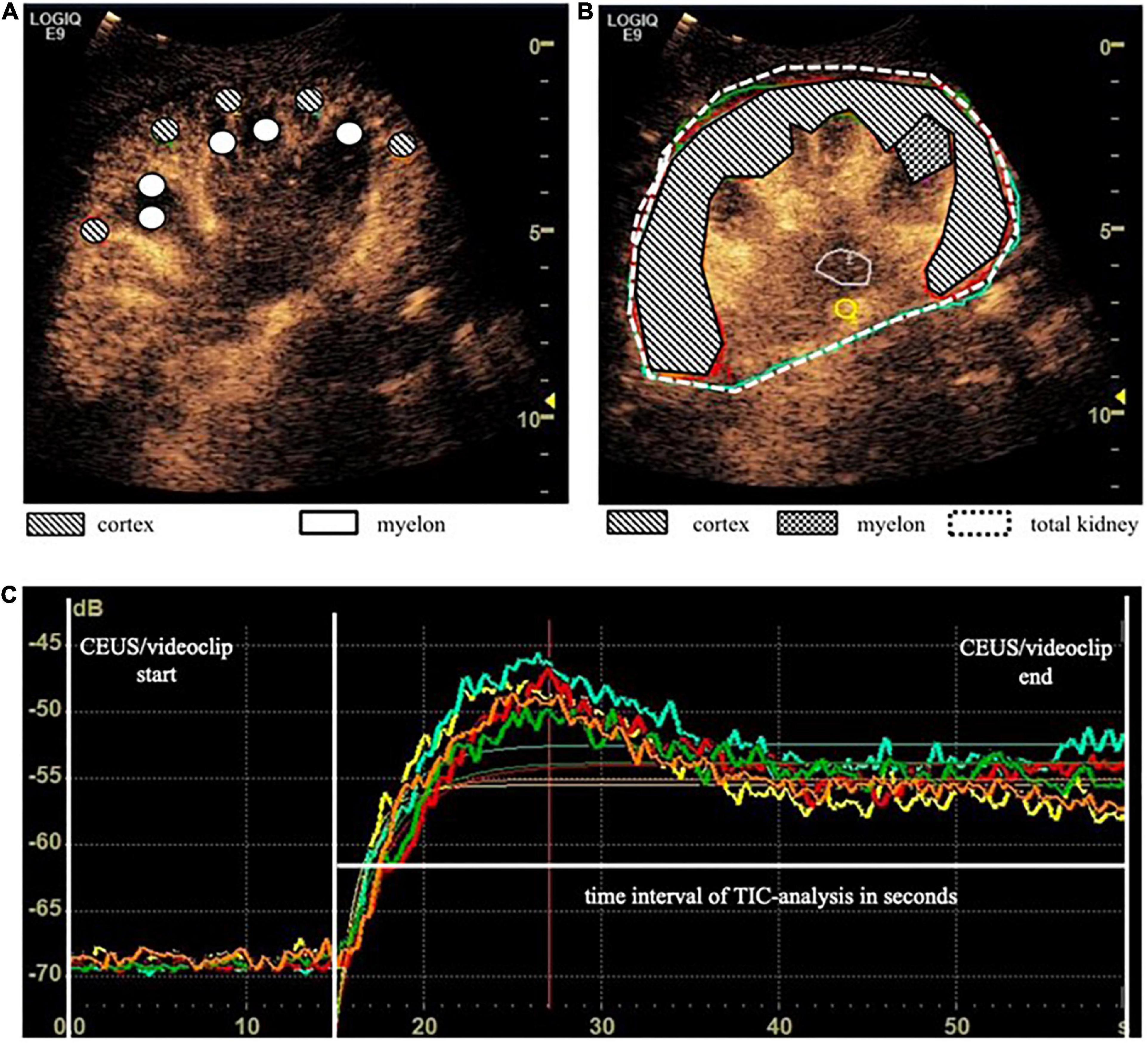 Creatinine level variation in patients subjected to contrast