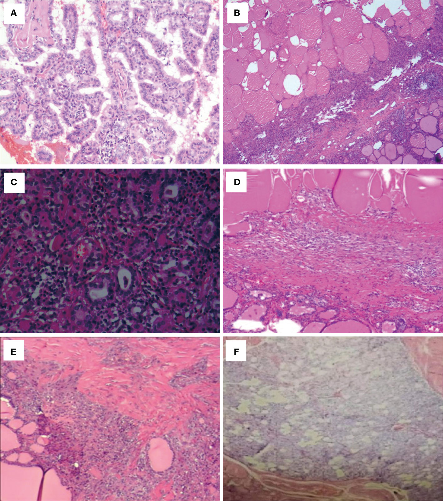 papillary thyroid carcinoma gross