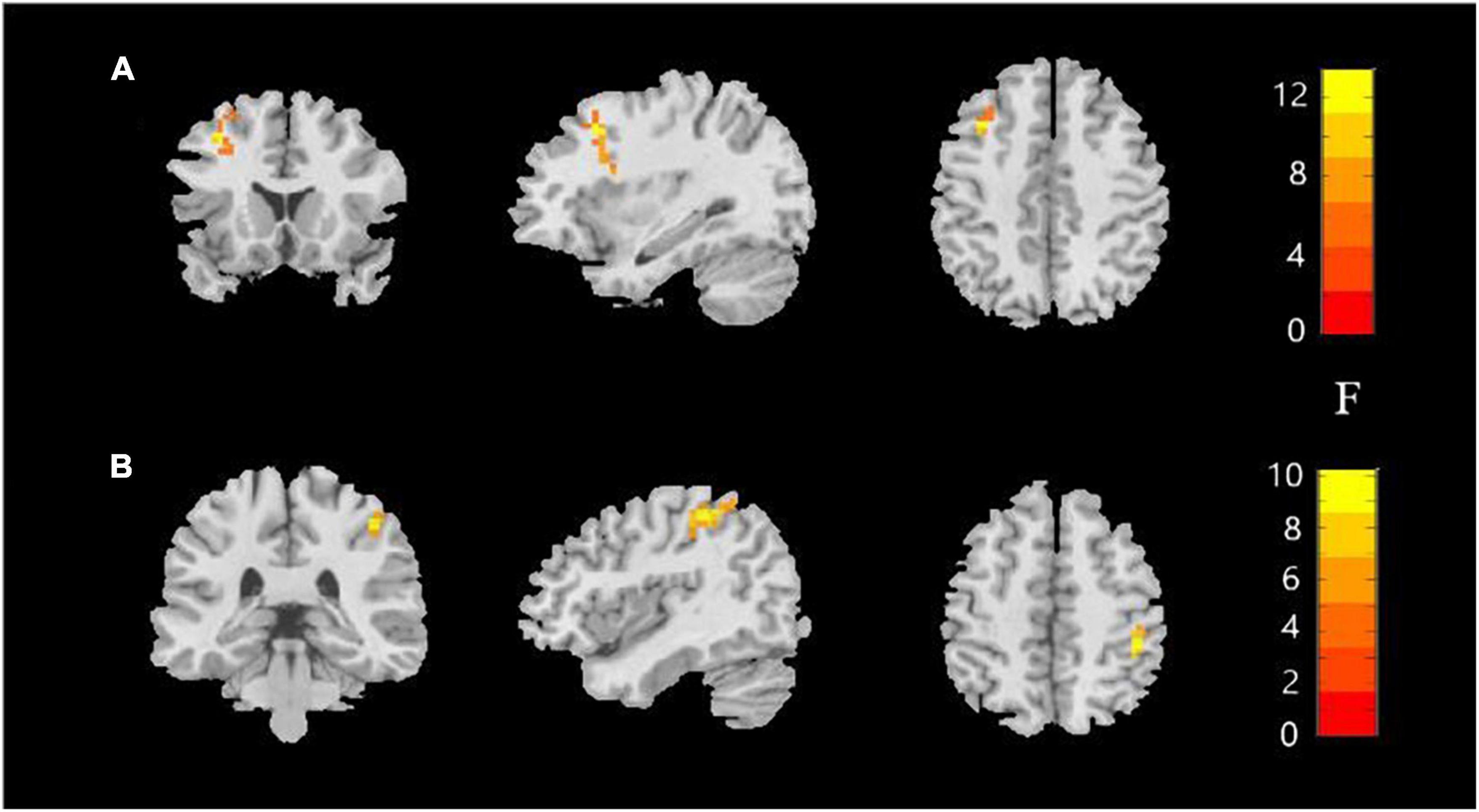 Frontiers  Neural activity in adults with major depressive disorder  differs from that in healthy individuals: A resting-state functional  magnetic resonance imaging study