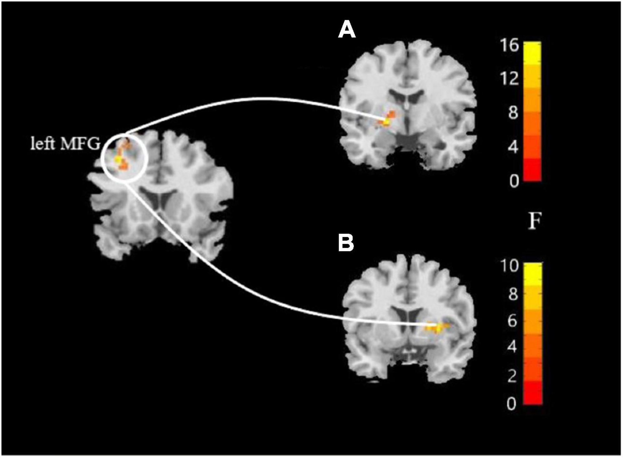 Frontiers  Neural activity in adults with major depressive disorder  differs from that in healthy individuals: A resting-state functional  magnetic resonance imaging study