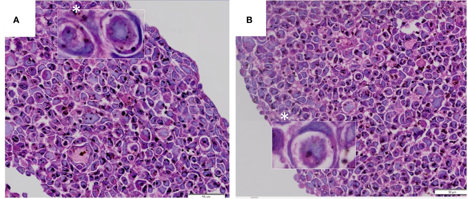 Frontiers  Cell-in-Cell Events in Oral Squamous Cell Carcinoma