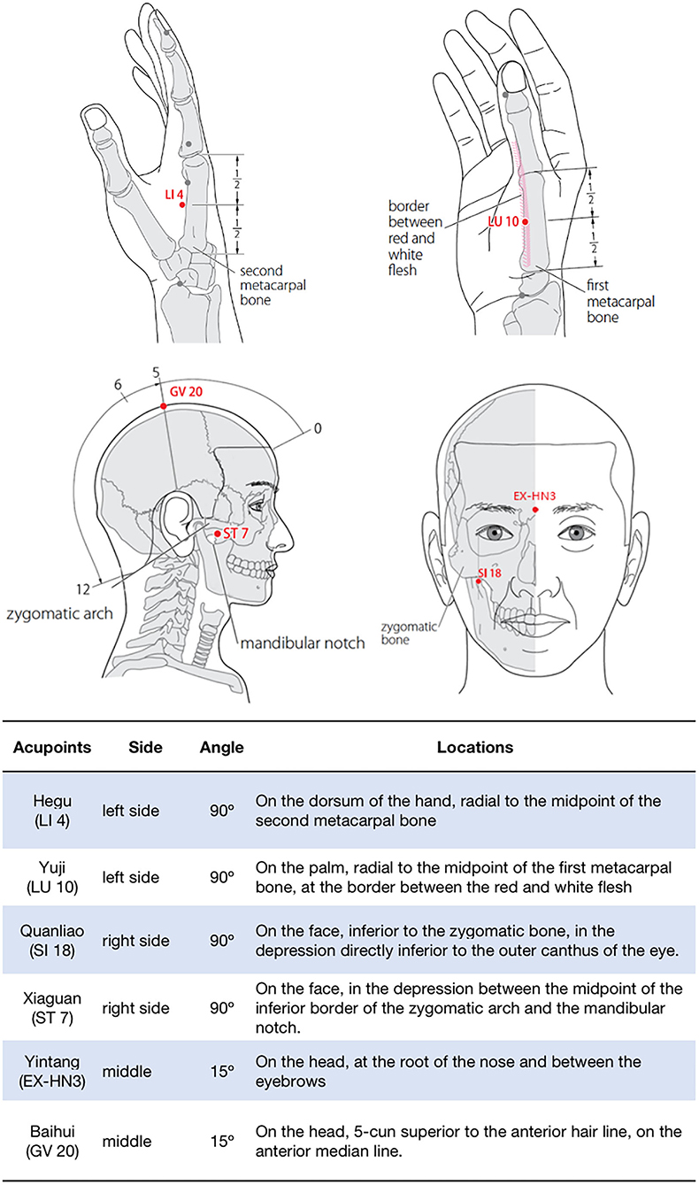 Motor points of face for electrical stimulation of bell's palsy