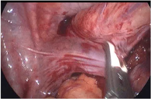 Case 52-1991 — An Eight-Year-Old Girl with Recurrent Abdominal Distention  after Surgical Correction of Hirschsprung's Disease