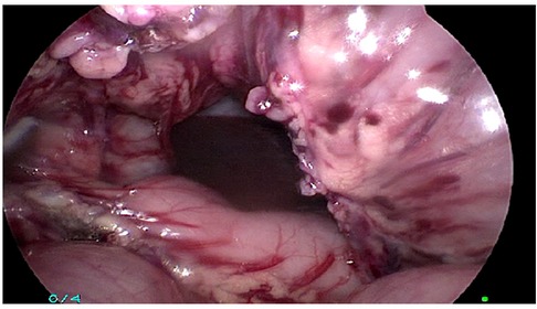 Case 52-1991 — An Eight-Year-Old Girl with Recurrent Abdominal Distention  after Surgical Correction of Hirschsprung's Disease