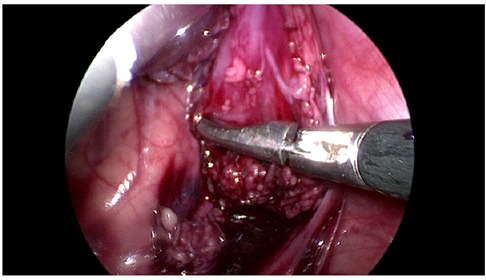 Case 52-1991 — An Eight-Year-Old Girl with Recurrent Abdominal Distention  after Surgical Correction of Hirschsprung's Disease