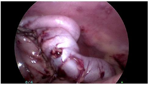 Case 52-1991 — An Eight-Year-Old Girl with Recurrent Abdominal Distention  after Surgical Correction of Hirschsprung's Disease