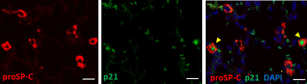 Frontiers | Senescence of alveolar epithelial cells impacts initiation ...