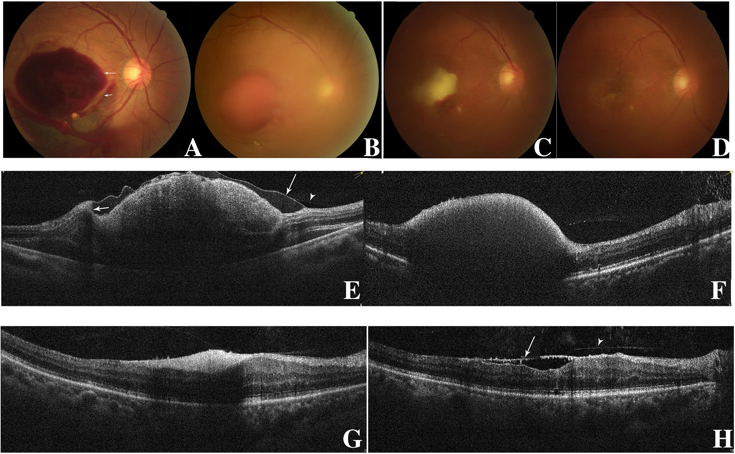 Nontraumatic intravasation of myelographic contrast medium