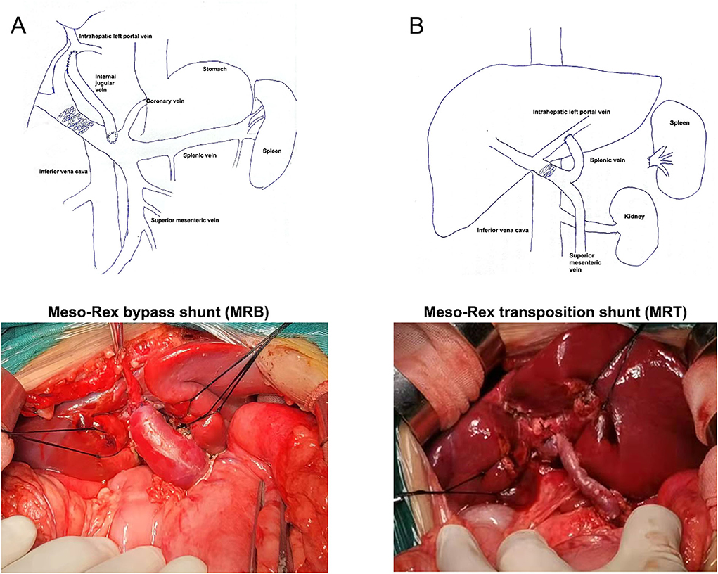 Frontiers  Meso-Rex bypass shunt vs. transposition shunt for cavernous  transformation of portal vein in children