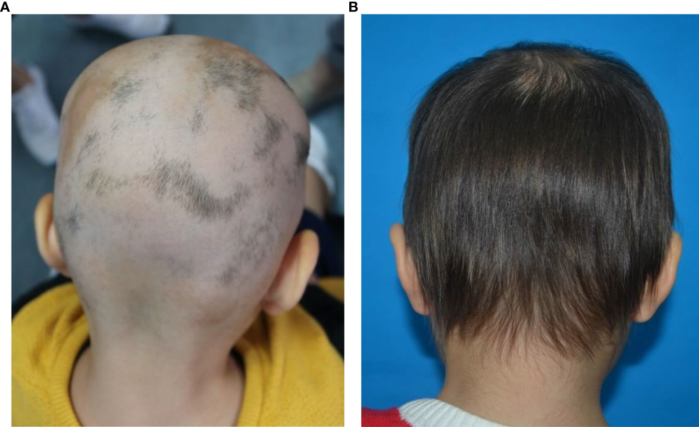 Frontiers | Microneedling combined with compound betamethasone in treatment  of severe alopecia areata: A case report