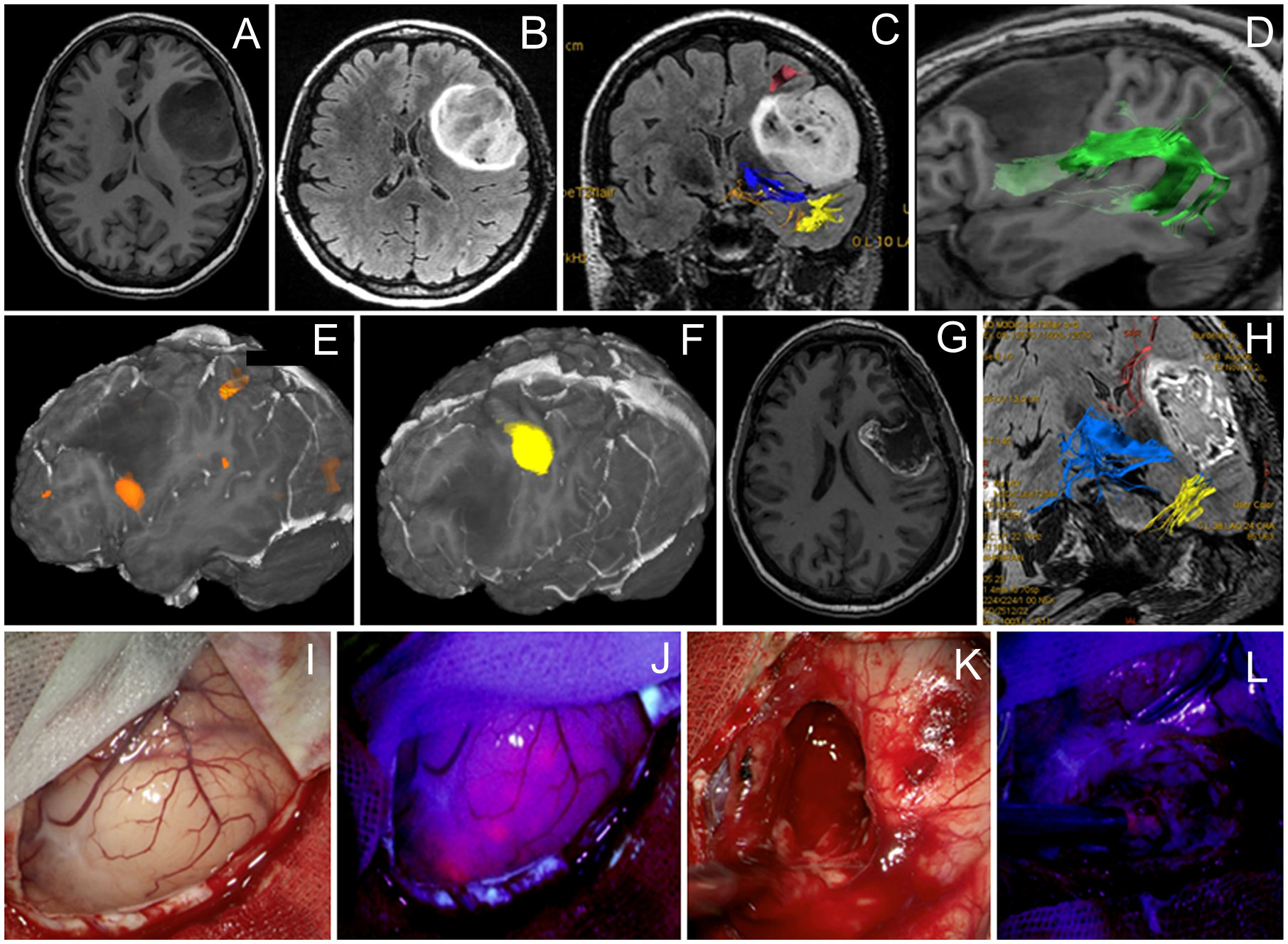 Perioperative Glycemia Management in Patients Undergoing Craniotomy for  Brain Tumor Resection: A Global Survey of Neuroanesthesiologists'  Perceptions and Practices - ScienceDirect