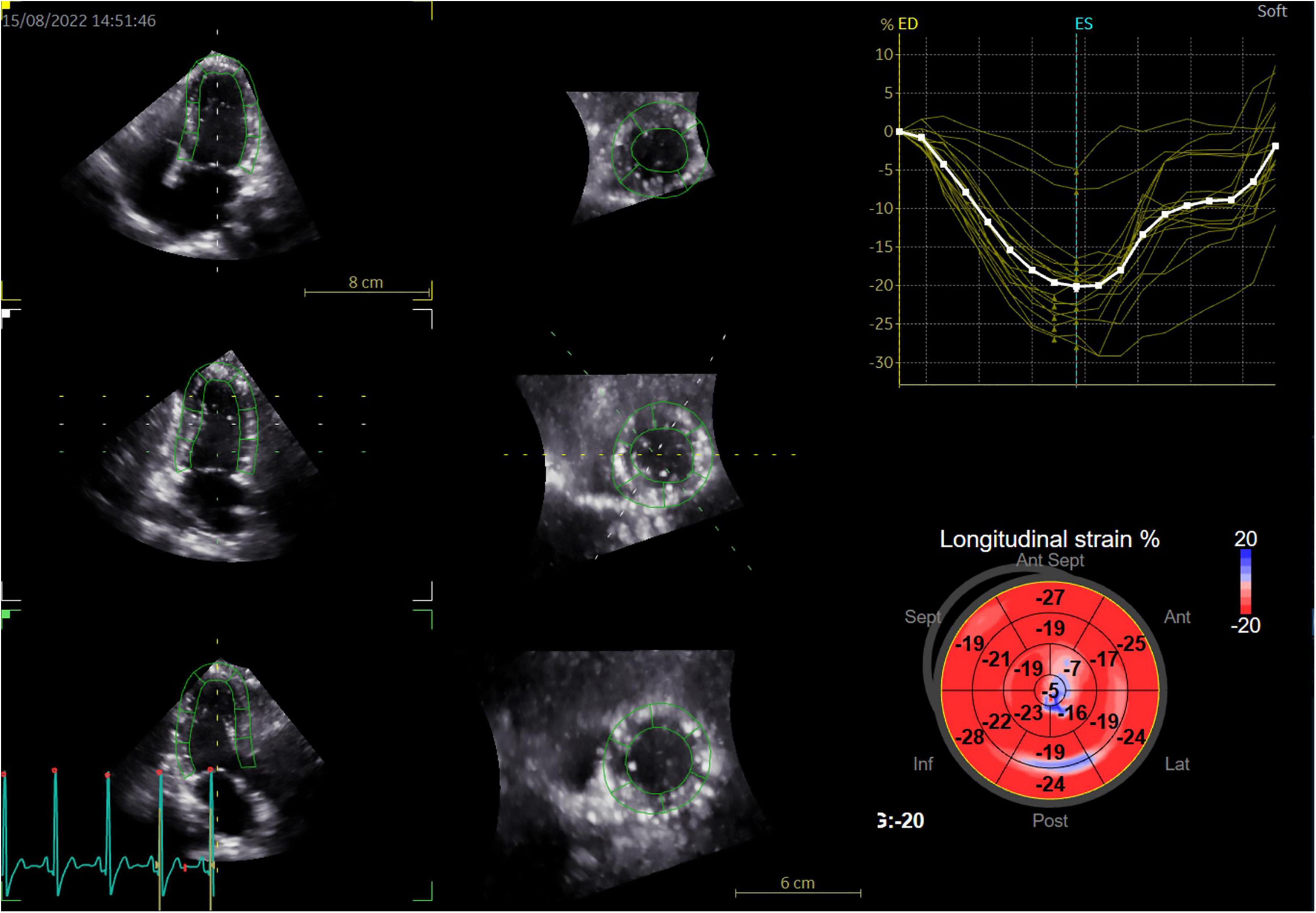 Interpreting the bull's-eye plot in speckle tracking echocardiogr